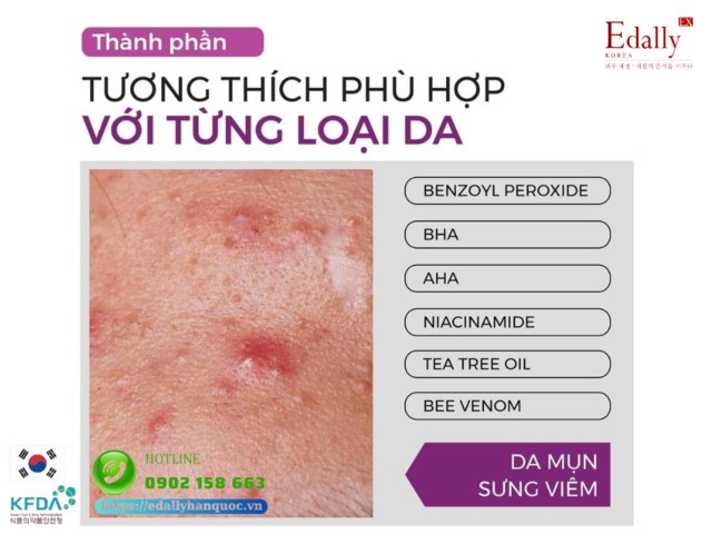 Cách lựa chọn thành phần mỹ phẩm phù hợp với làn da mụn sưng viêm