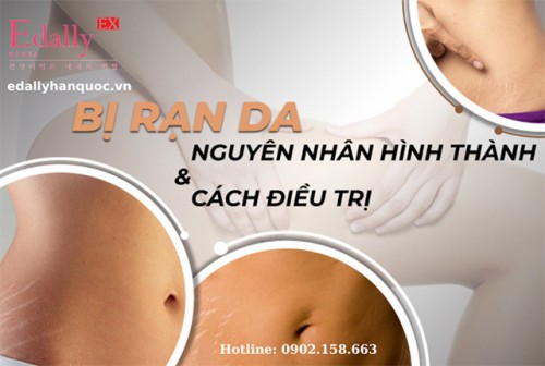 Bị Rạn Da Phải Làm Sao?