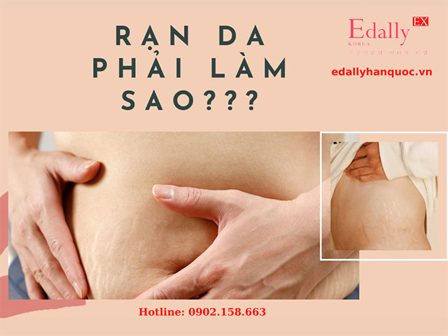 Bị rạn da thì phải làm sao?