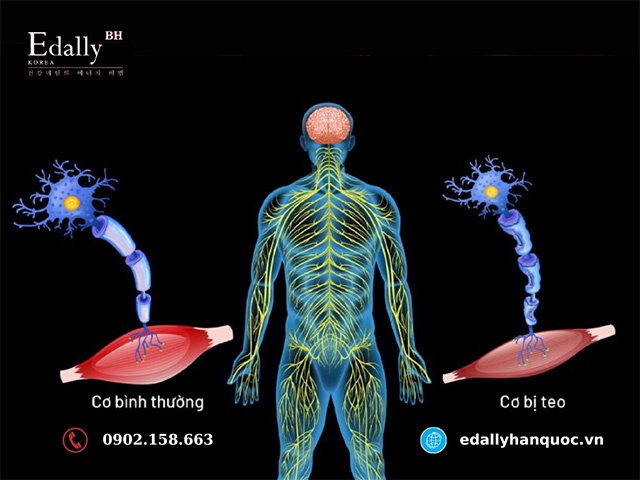 Teo cơ do biến chứng của bệnh đái tháo đường