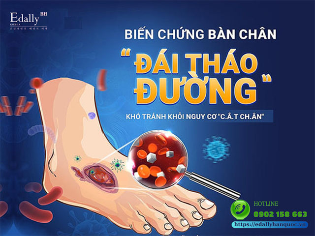 Biến chứng bàn chân do bệnh tiểu đường khó tránh khỏi nguy cơ cắt cụt chi