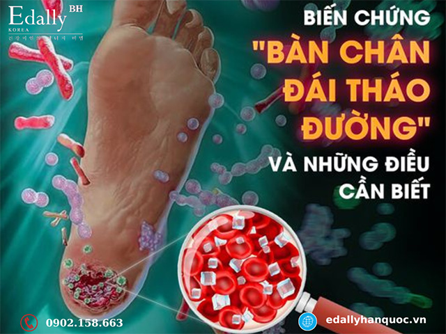 Biến chứng bàn chân đái tháo đường và những điều cần biết