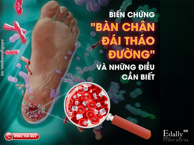 Biến chứng bàn chân đái tháo đường có thể dẫn đến cắt cụt chi