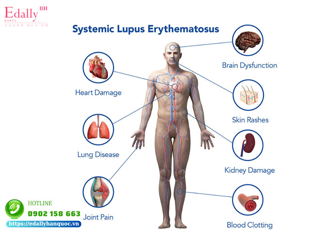 Ảnh hưởng của bệnh Lupus ban đỏ hệ thống lên các cơ quan trong cơ thể