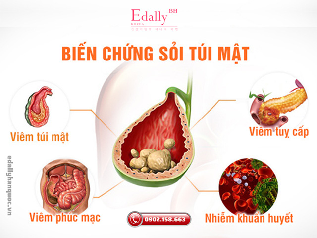 Bệnh sỏi túi mật và những biến chứng nguy hiểm