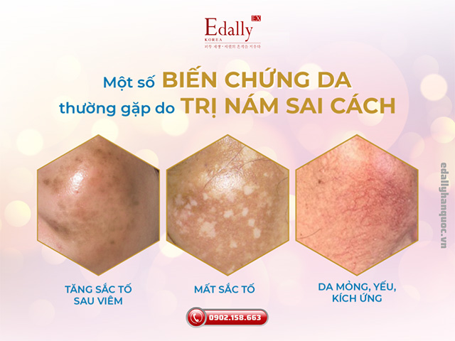 Những biến chứng thường gặp về da khi điều trị nám da không đúng cách