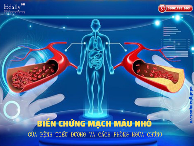 Các biến chứng mạch máu nhỏ do bệnh tiểu đường và cách phòng ngừa chúng hiệu quả