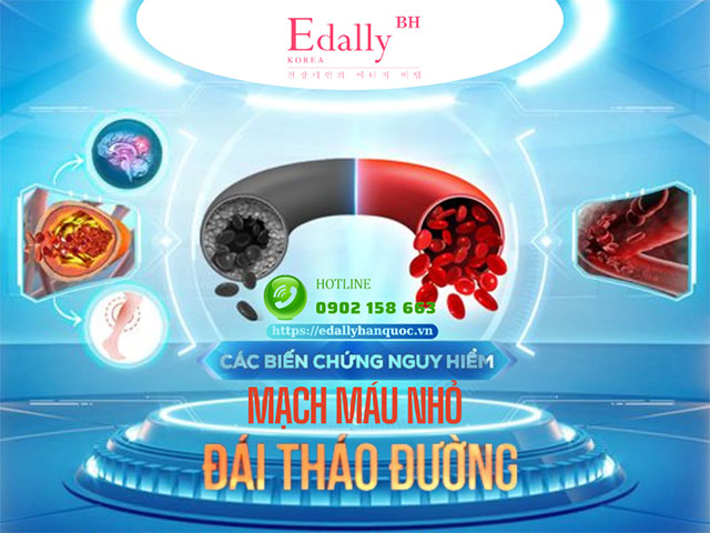 Biến chứng mạch máu nhỏ ở người tiểu đường và các ảnh hưởng nguy hiểm đến mắt, tim mạch, thận…