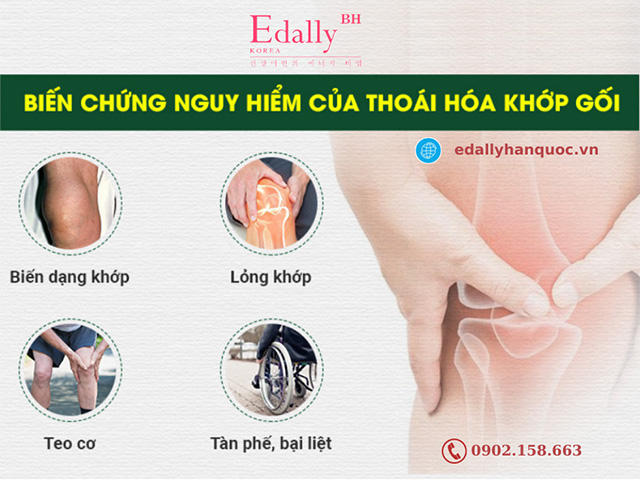 Những biến chứng nguy hiểm của bệnh thoái hóa khớp gối gây ra