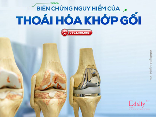 Bị bệnh thoái hóa gớp gối gây ra những biến chứng gì?