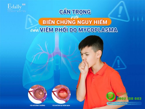 Viêm Phổi Do Mycoplasma - Biến Chứng Nguy Hiểm Chớ Coi Thường