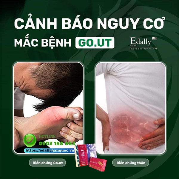 Biến chứng nguy hiểm nhất của bệnh Gout là suy thận