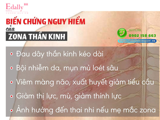 Các biến chứng nguy hiểm của bệnh zona thần kinh