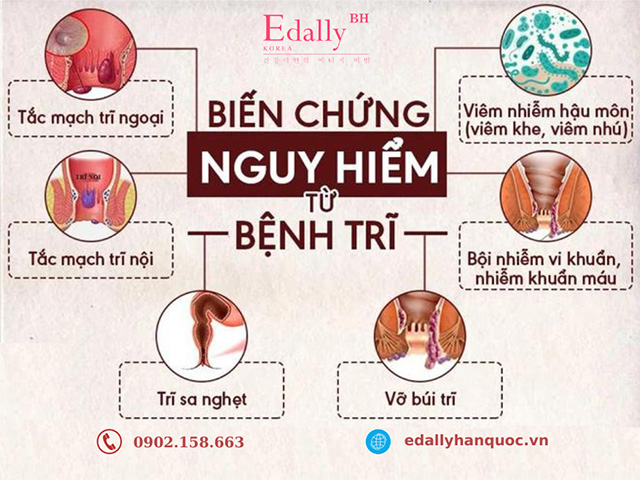 Biến chứng nguy hiểm do bệnh trĩ gây ra