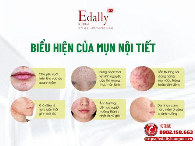 Biểu hiện của mụn nội tiết
