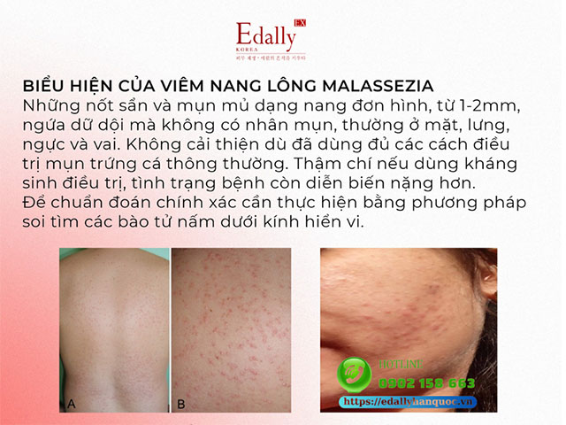 Biểu hiện của bệnh nấm men