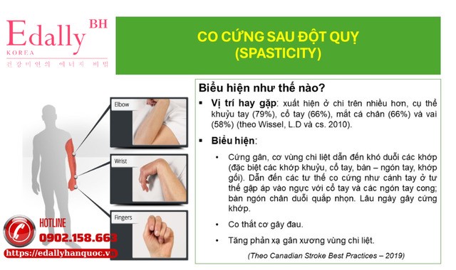 Co cứng sau đột quỵ não và chấn thương sọ não có biểu hiện như thế nào?