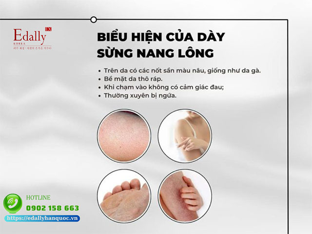 Dấu hiệu nhận biết của dày sừng nang lông