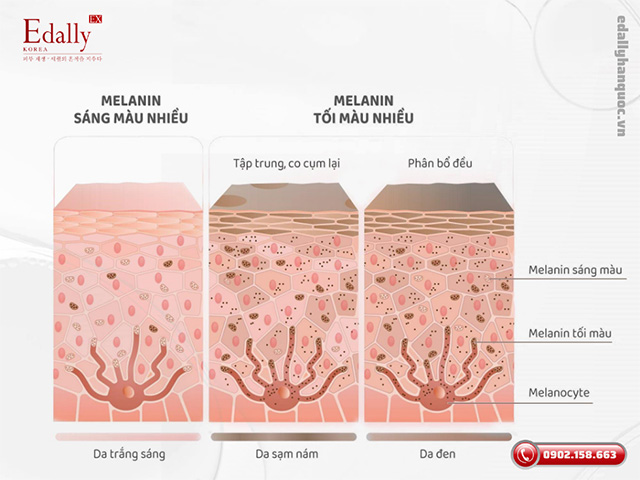 Biểu hiện của sắc tố melanin trên da