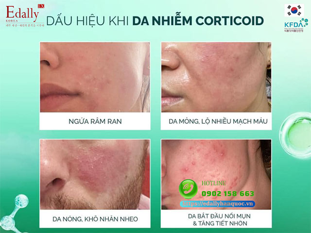 Biểu hiện của làn da bị nhiễm Corticoid