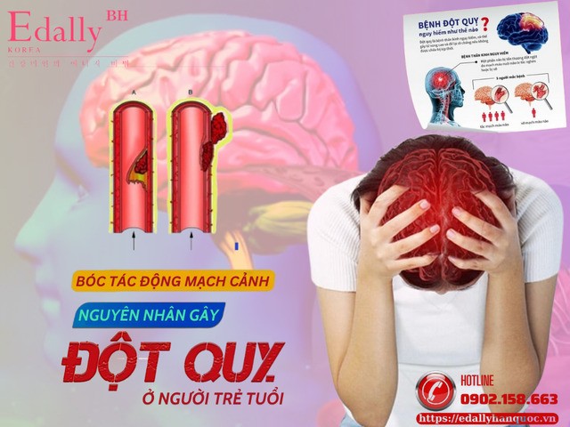 Bóc tách động mạch cảnh, nguyên nhân gây đột quỵ ở người trẻ tuổi Bóc tách động mạch cảnh, nguyên nhân gây đột quỵ ở người trẻ tuổi