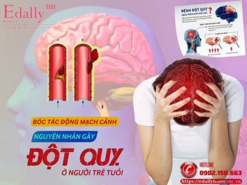 Bóc Tách Động Mạch Cảnh, Nguyên Nhân Gây Đột Quỵ Ở Người Trẻ