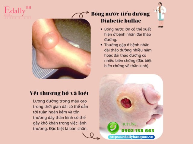 Bóng nước tiểu đường và vết thương hở, loét là dấu hiệu ở da cảnh báo bệnh đái tháo đường