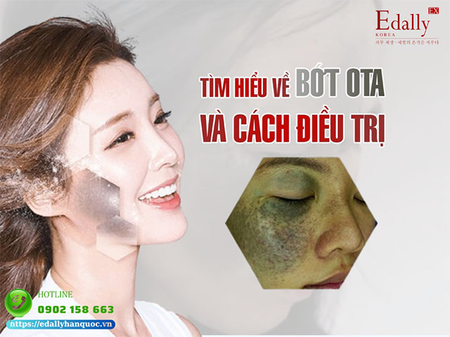 Tìm hiểu về bớt Ota và cách điều trị