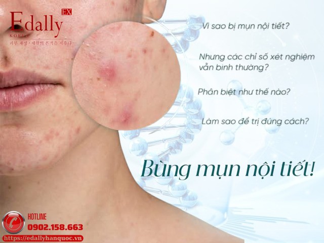 Bùng mụn nội tiết sau Tết và cách để kiểm soát hiệu quả