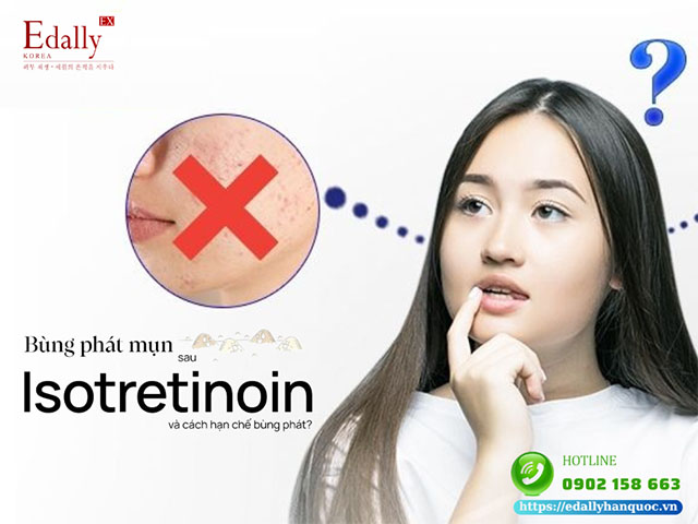 Bùng phát mụn sau khi sử dụng isotretinoin và cách hạn chế bùng phát