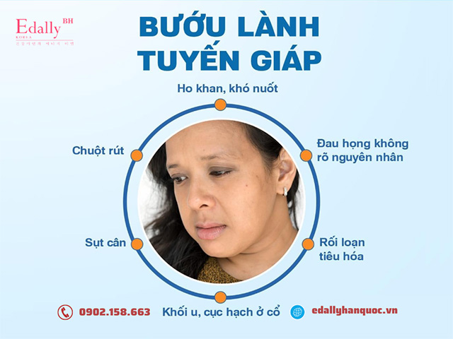 Bệnh bướu lành tuyến giáp