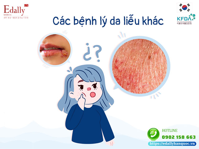 Các bệnh lý da liễu khác do nhiễm độc Corticoid gây ra