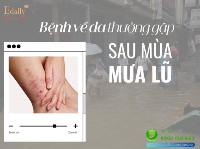 Các bệnh về da thường gặp sau mùa mưa lũ và cách điều trị, phòng ngừa hiệu quả