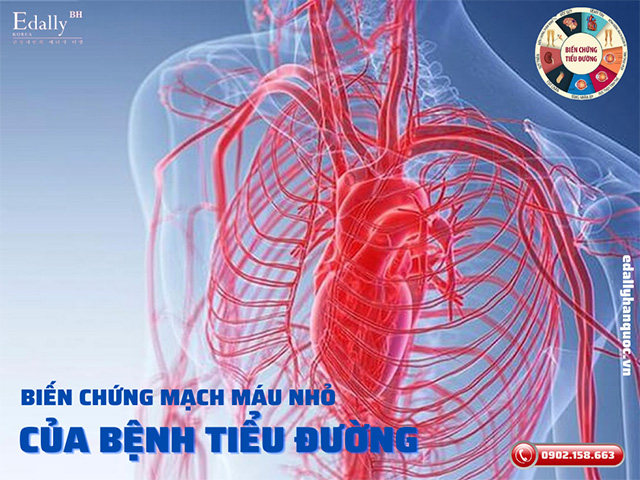 Các biến chứng mạch máu nhỏ do bệnh tiểu đường gây ra