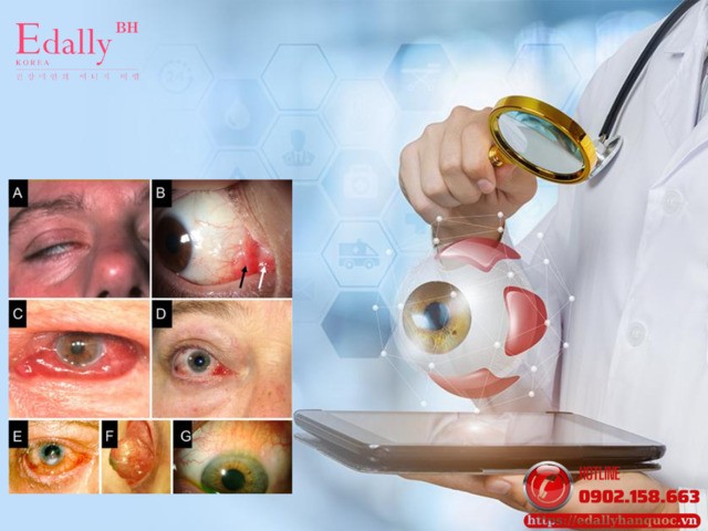 Các dạng biến chứng mắt nặng do bệnh Basedow