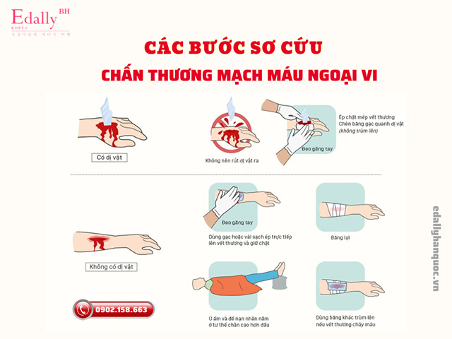 Các bước sơ cứu chấn thương mạch máu ngoại vi