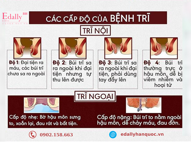 Các cấp độ bệnh trĩ