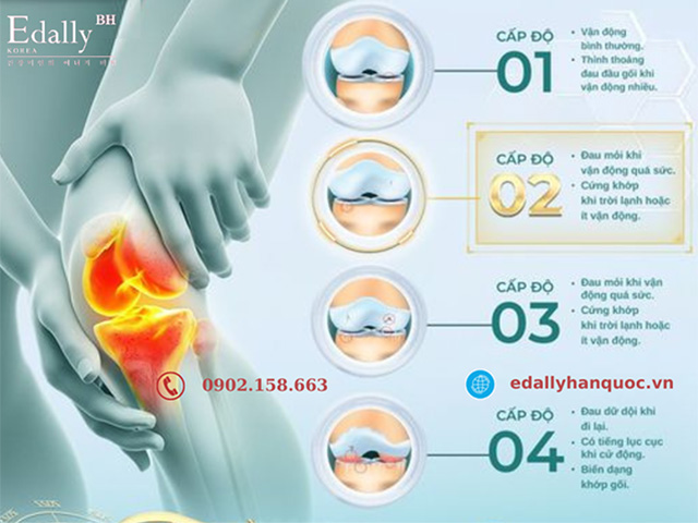 Các cấp độ tiến triển của bệnh thoái hóa khớp gối