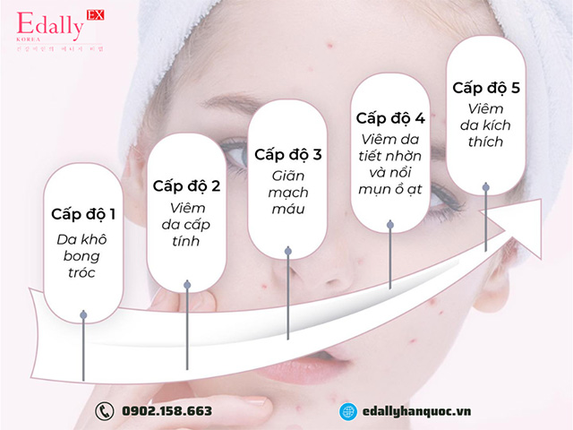 Các cấp độ da bị nhiễm độc tố Corticoid