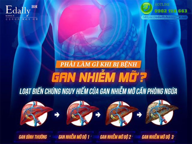 Các cấp độ gan nhiễm mỡ trên siêu âm