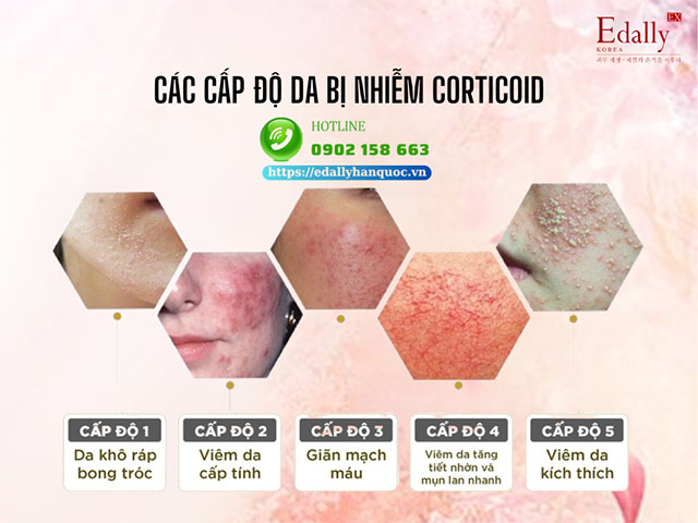 Các cấp độ của da bị nhiễm Corticoid