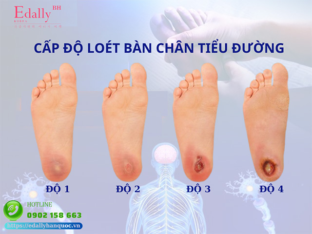 Các cấp độ loét bàn chân ở người bệnh tiểu đường