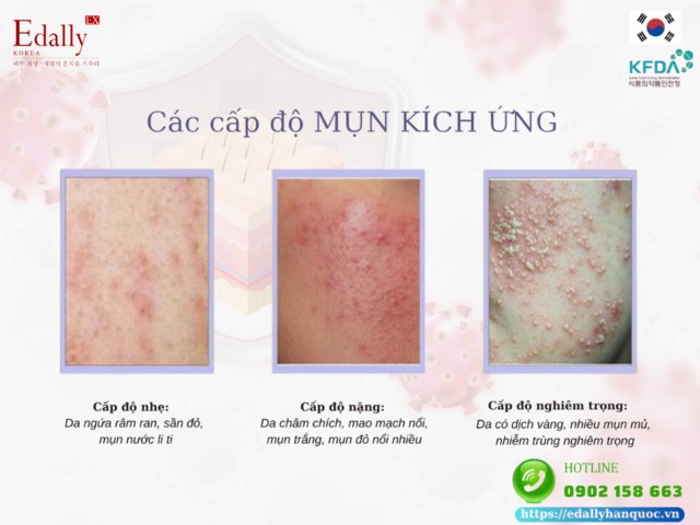 3 cấp độ của mụn kích ứng