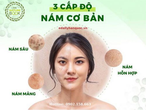 Nám Da Và Cách Trị Nám Da Hiệu Quả