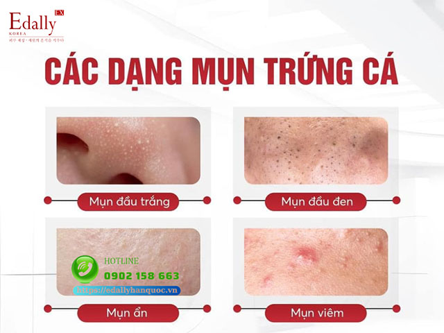 Các dạng mụn trứng cá thường gặp