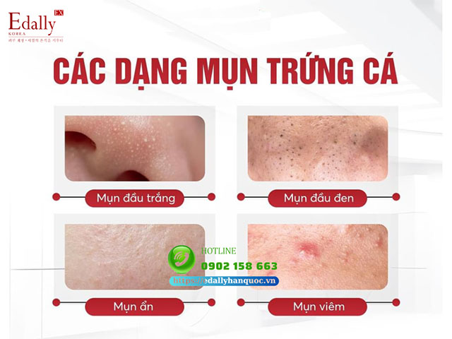 Các dạng da mụn trứng cá thường gặp