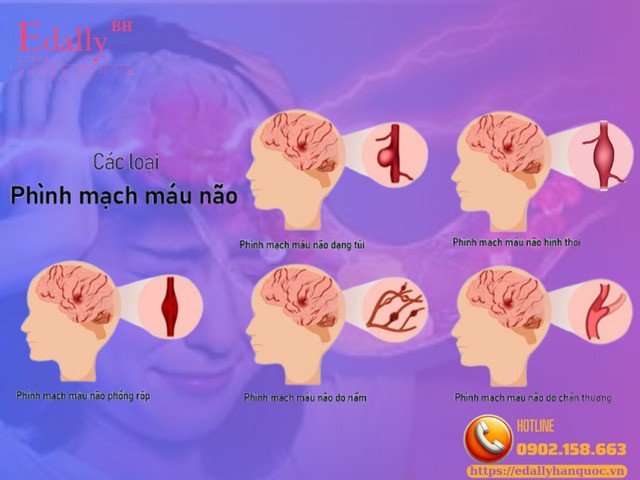 Các dạng phình mạch máu não