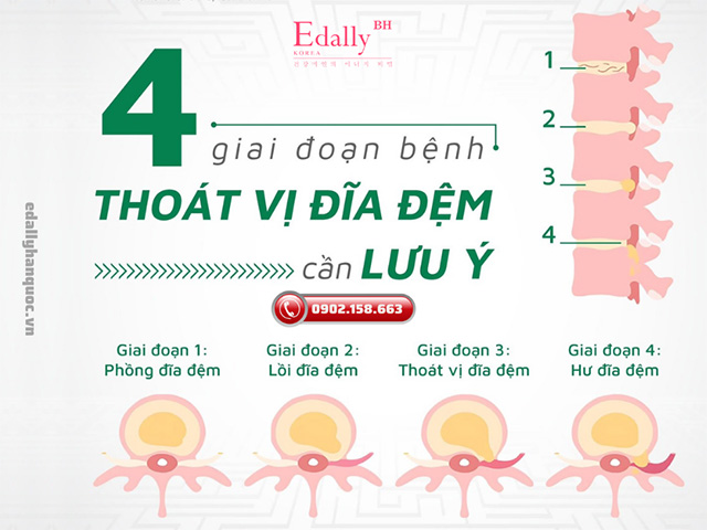 4 giai đoạn bệnh thoát vị đĩa đệm cần lưu ý