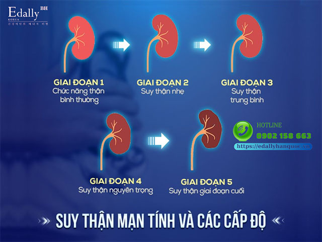 Các giai đoạn của bệnh suy thận mạn tính và những điều cần biết để cải thiện bệnh