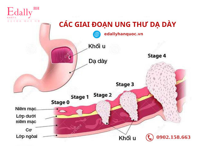 Các giai đoạn của bệnh ung thư dạ dày